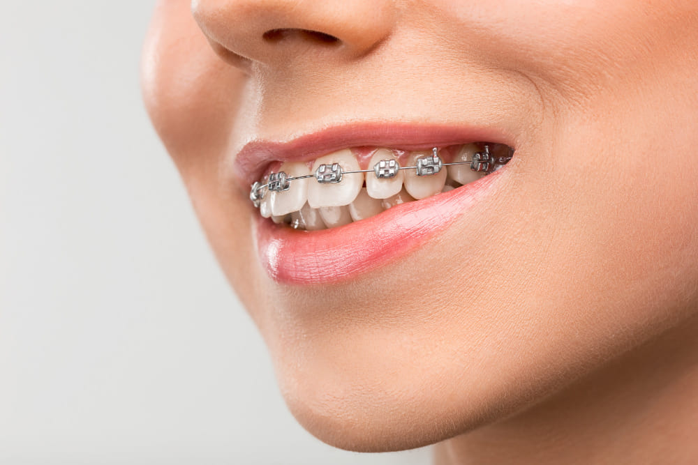 sonrisa-con-brackets-en-dentadura-blanca sonrisa-con-brackets-en-dentadura-blanca