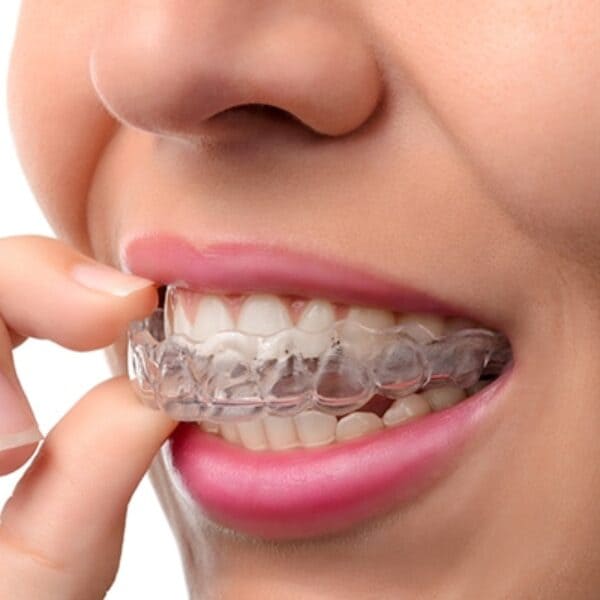 mujer colocando ferula dental proteccion bruxismo