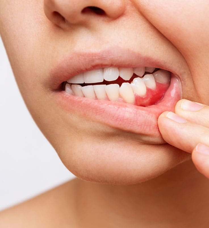 mujer levantando labio encias inflamadas gingivitis