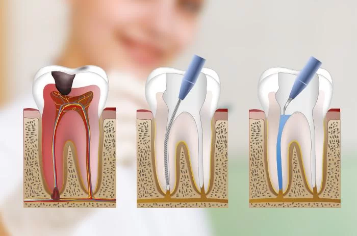 render endodoncia madrid