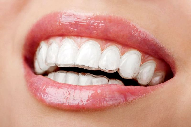 sonrisa ortodoncia invisible alineador dental dientes blancos