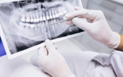 Implantes dentales con falta de hueso: ¿Es posible?