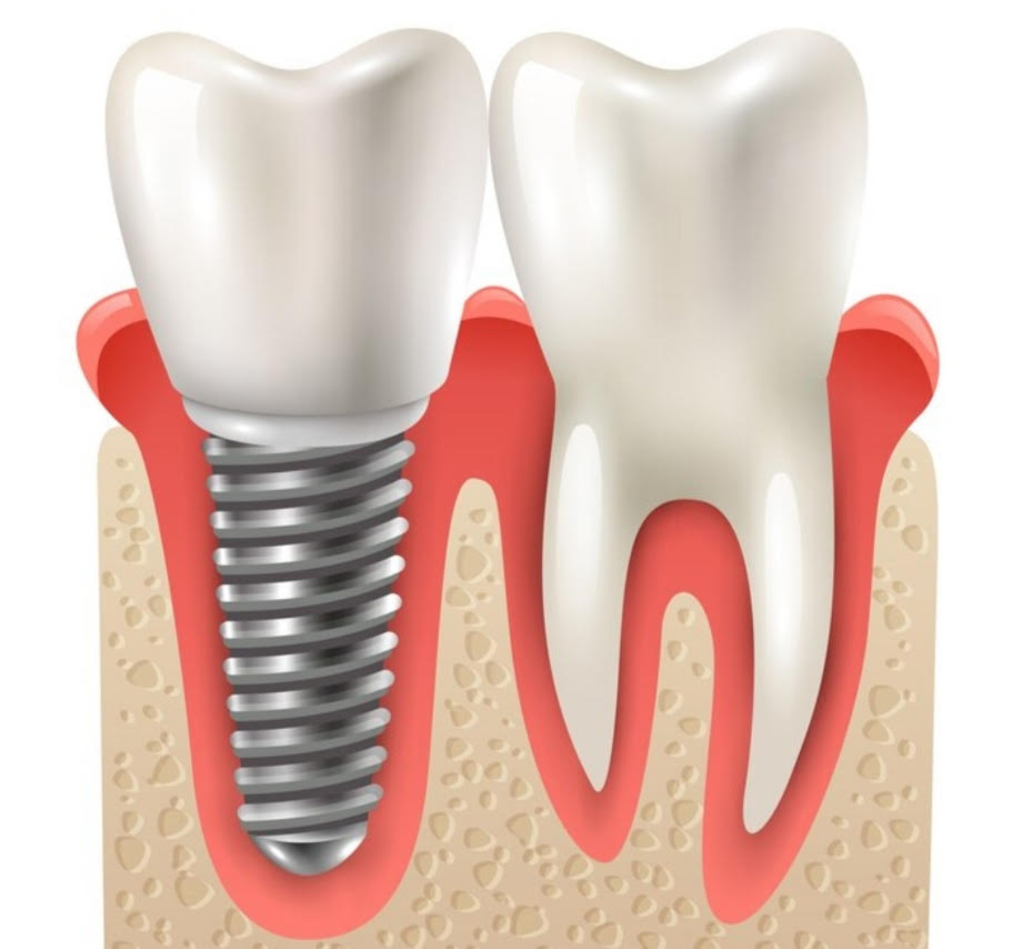implante dental sobre encia con ilustracion de raiz